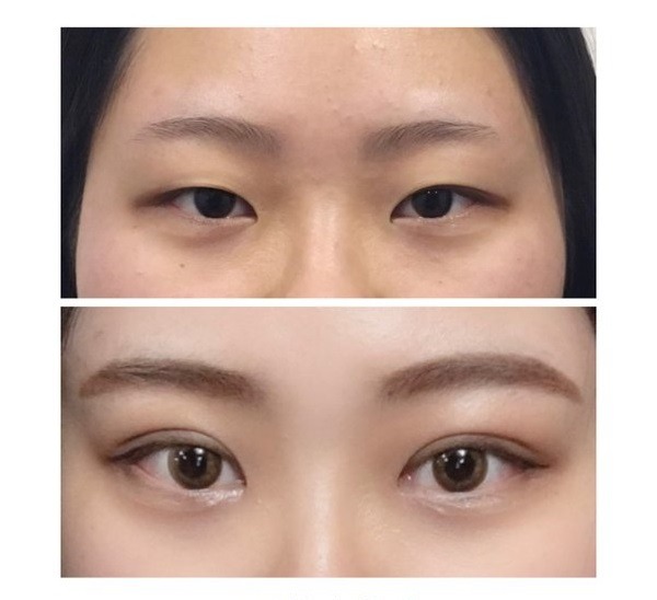 Affordable Blepharoplasty NYC Cost