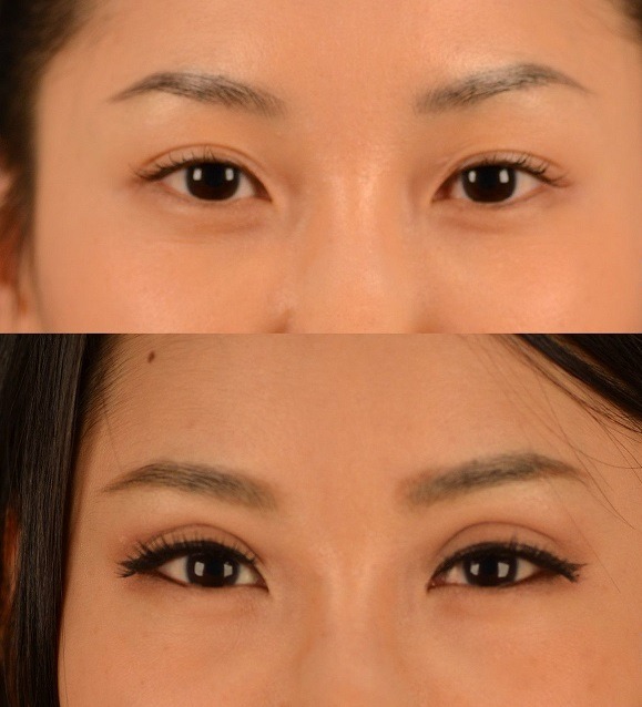 Eyelid Surgery Cost NYC