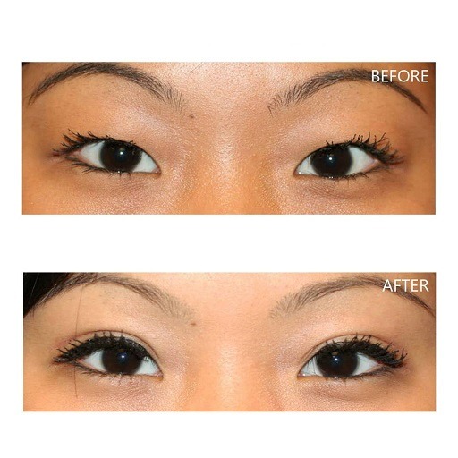 cheap blepharoplasty nyc cost