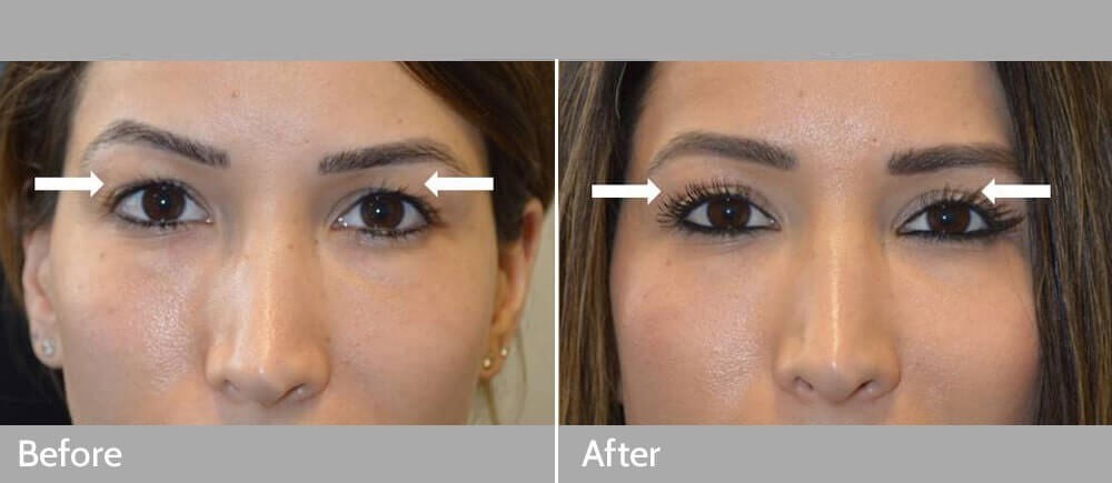 upper and lower blepharoplasty cost nyc