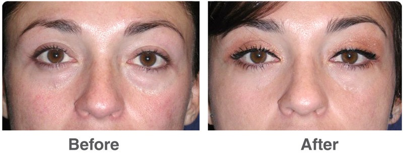 upper eyelid surgery cost in nyc cheap