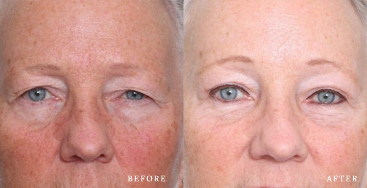 blepharoplasty cost nyc